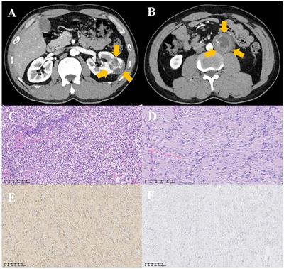 Retroperitoneal schwannoma mimicking a metastatic lymph node of renal clear cell carcinoma: a case report